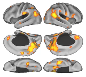 Brain scans showing enhanced hippocampal activity